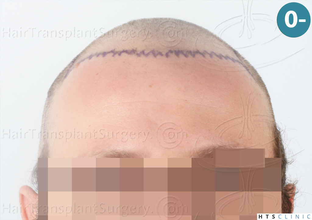 Dr.Devroye-HTS-Clinic-3054-FUE-7