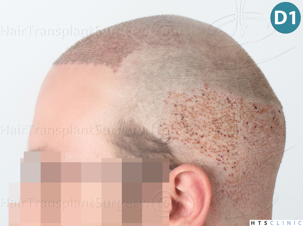 Dr.Devroye-HTS-Clinic-3054-FUE-11