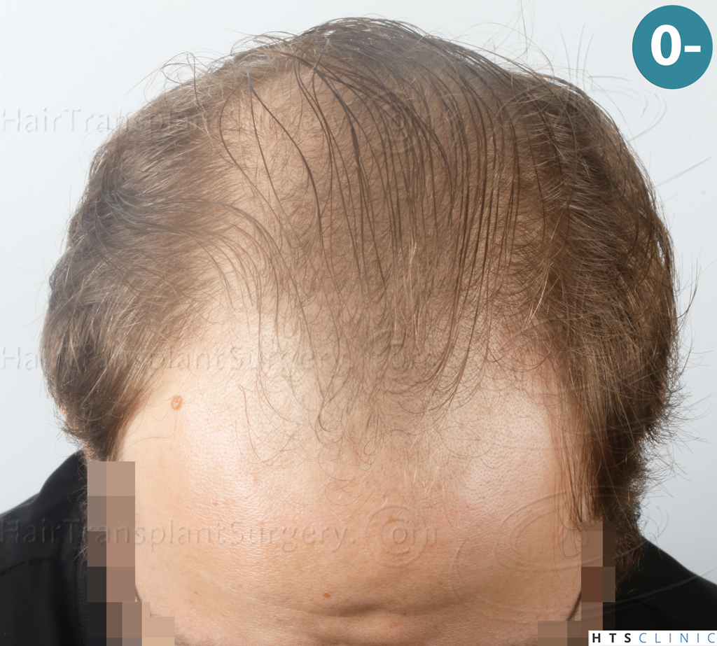 Dr.Devroye-HTS-Clinic-3054-FUE-2