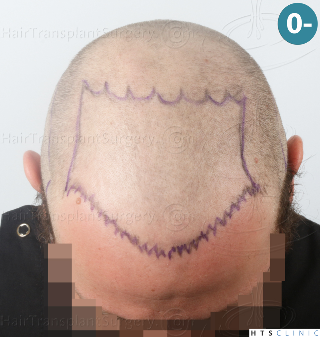 Dr.Devroye-HTS-Clinic-3054-FUE-8