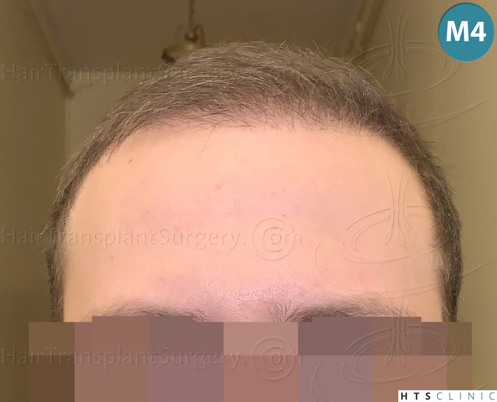 Dr.Devroye-HTS-Clinic-3054-FUE-16