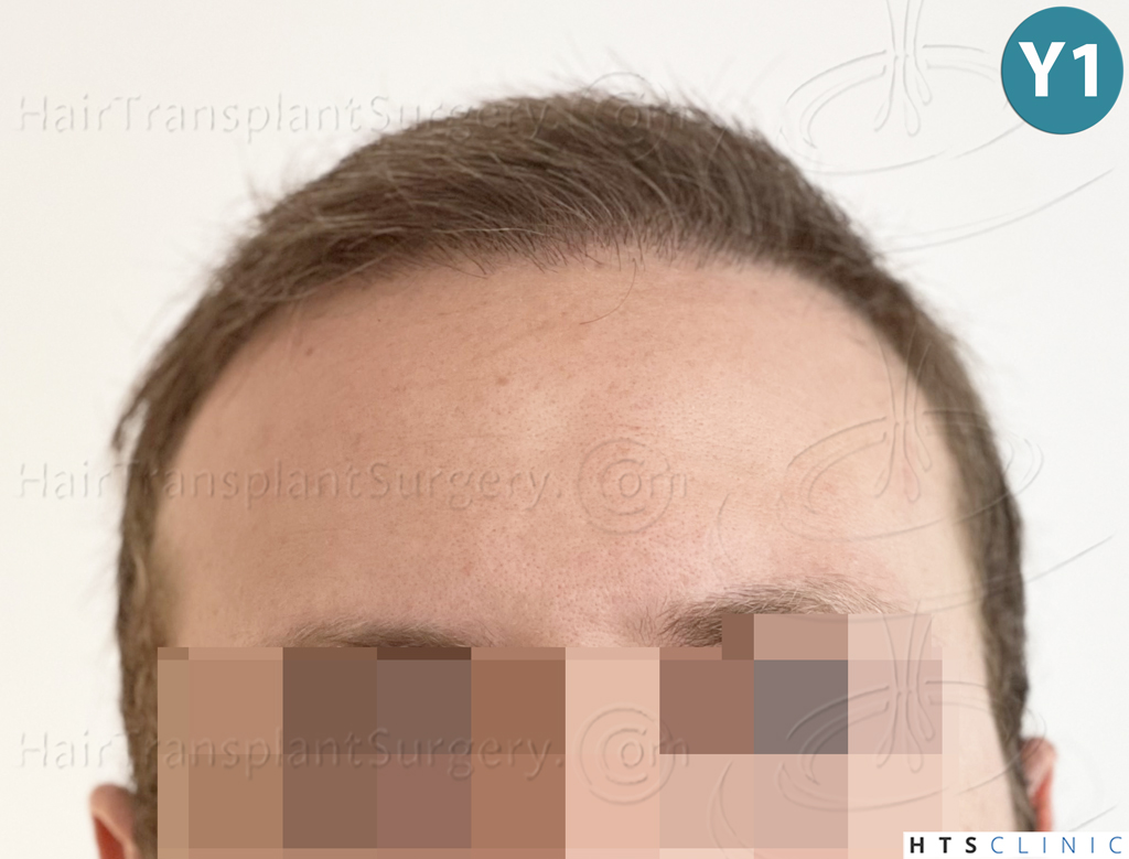 Dr.Devroye-HTS-Clinic-3054-FUE-24