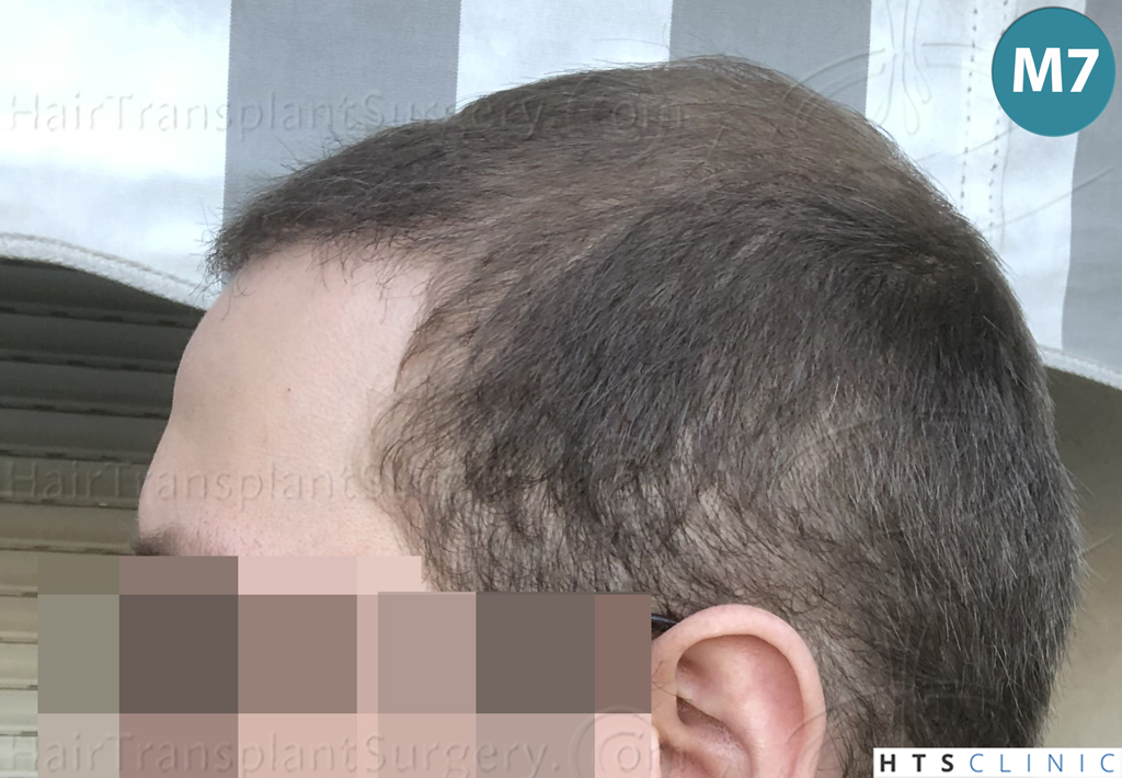 Dr.Devroye-HTS-Clinic-3054-FUE-22