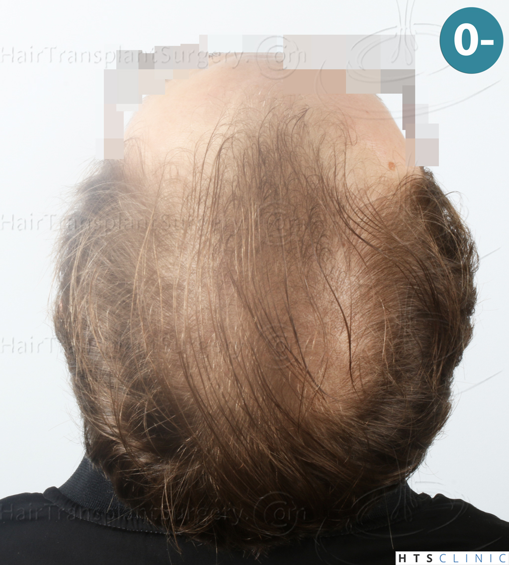 Dr.Devroye-HTS-Clinic-3054-FUE-6