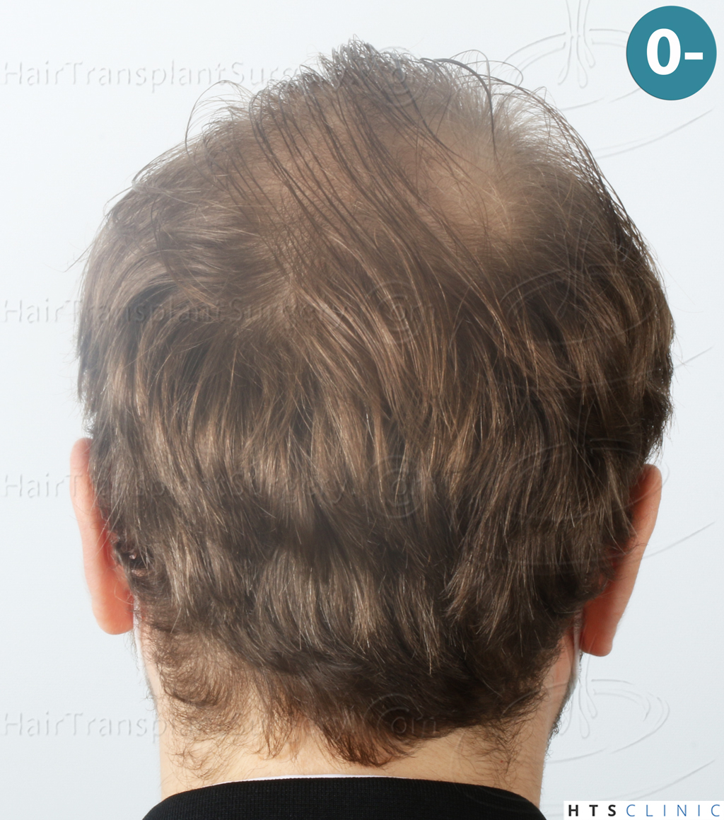 Dr.Devroye-HTS-Clinic-3054-FUE-5