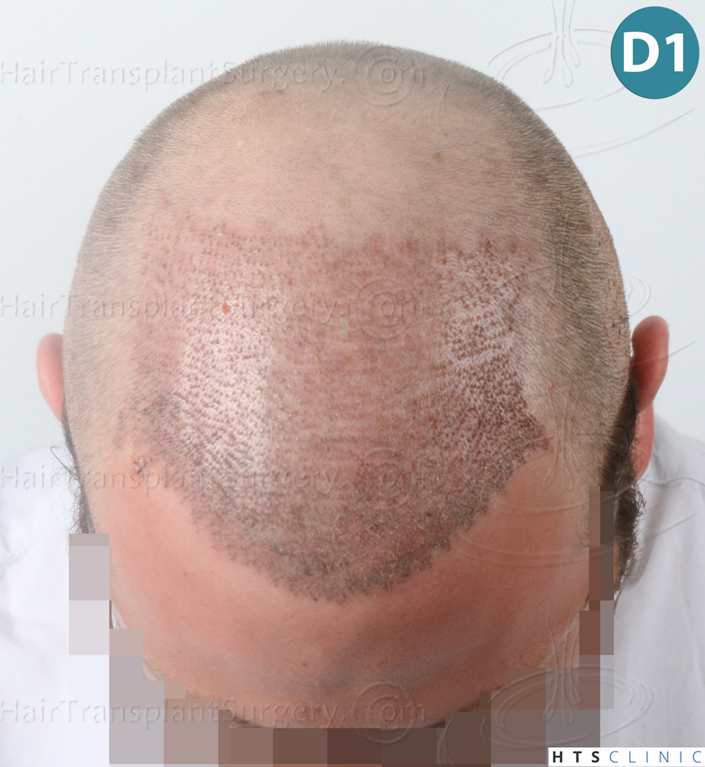 Dr.Devroye-HTS-Clinic-3054-FUE-10