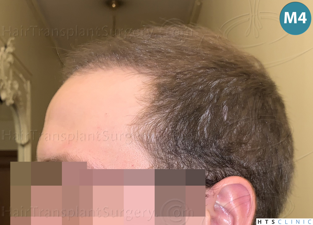 Dr.Devroye-HTS-Clinic-3054-FUE-18