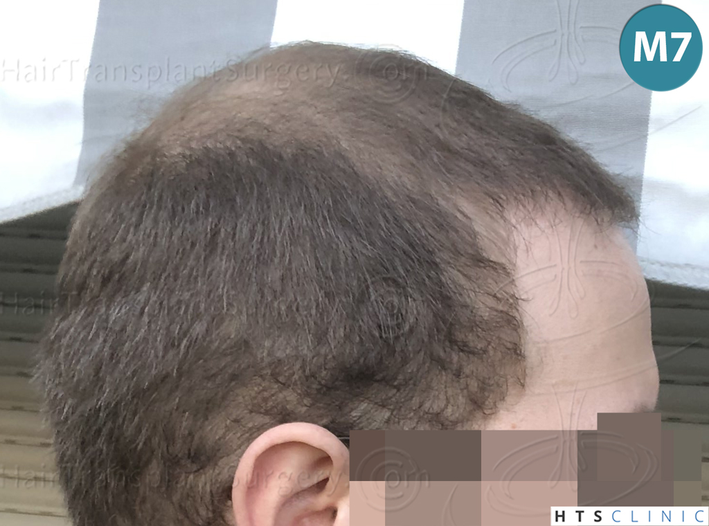 Dr.Devroye-HTS-Clinic-3054-FUE-23