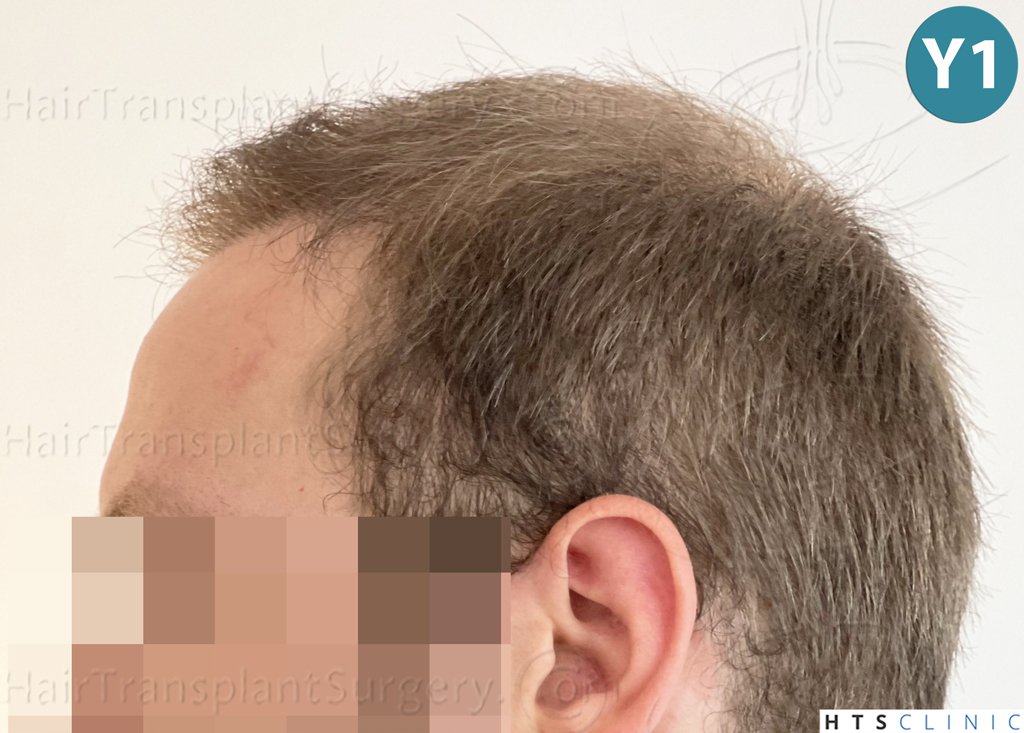 Dr.Devroye-HTS-Clinic-3054-FUE-26