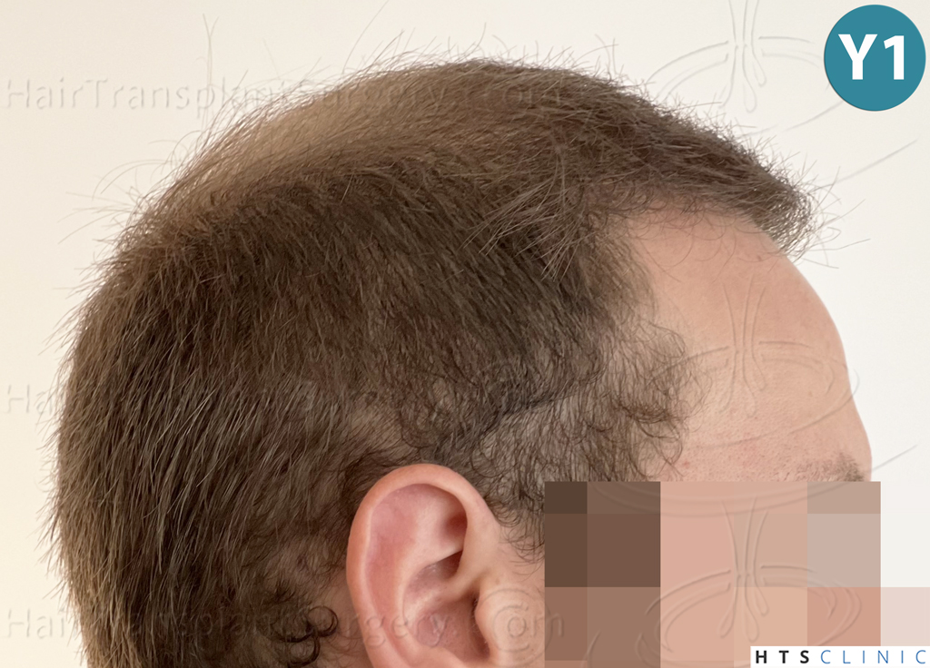 Dr.Devroye-HTS-Clinic-3054-FUE-27