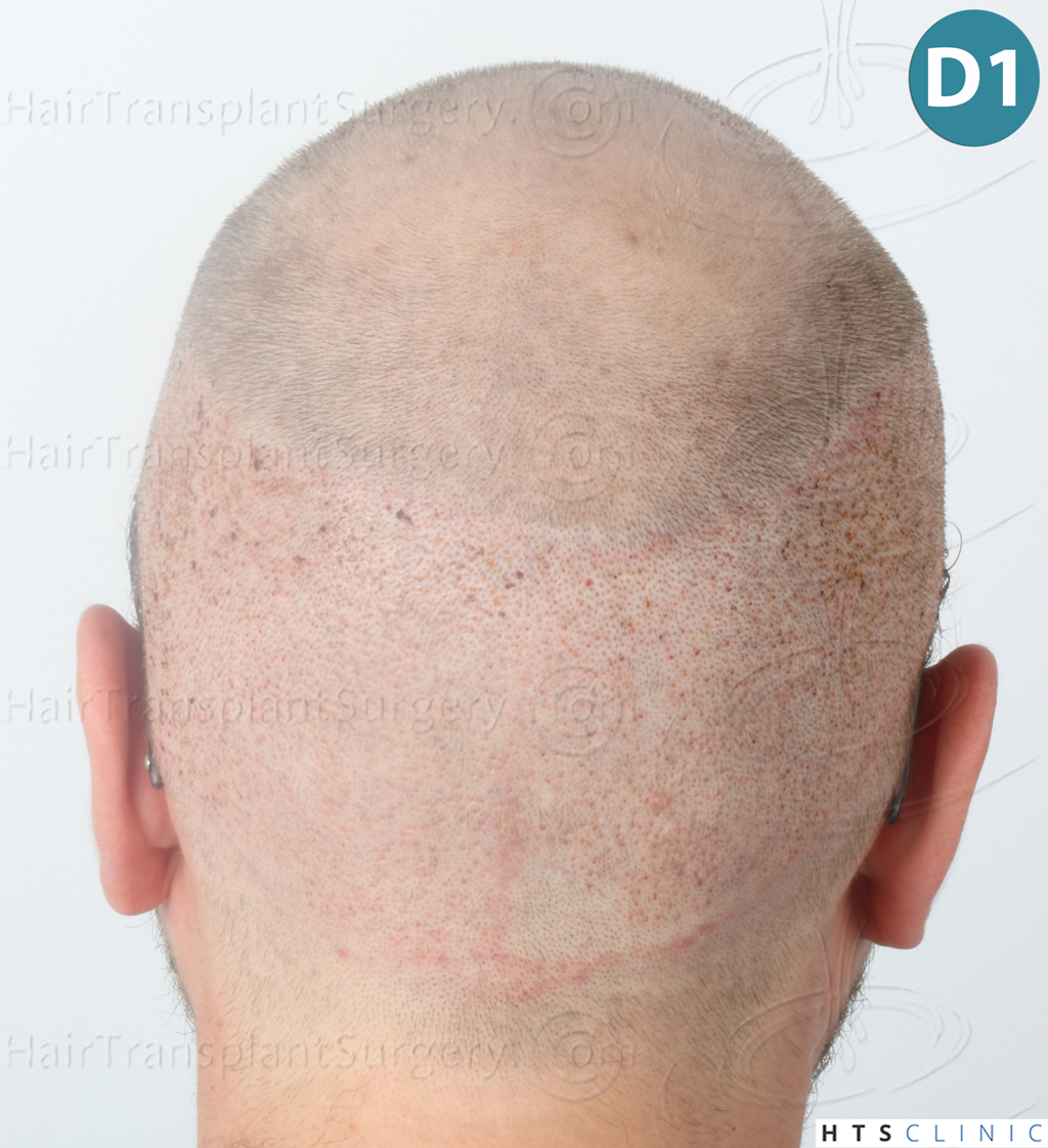 Dr.Devroye-HTS-Clinic-3054-FUE-13