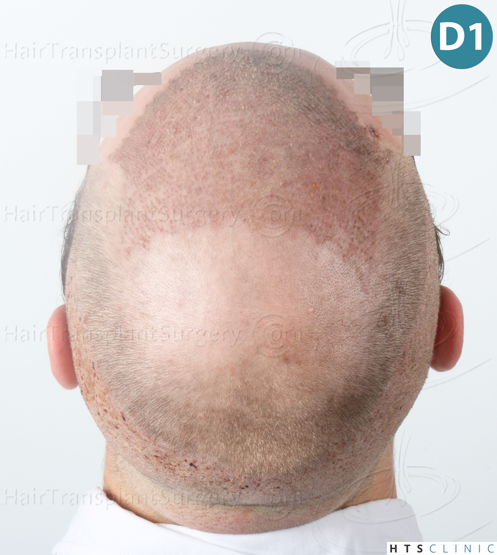 Dr.Devroye-HTS-Clinic-3054-FUE-14