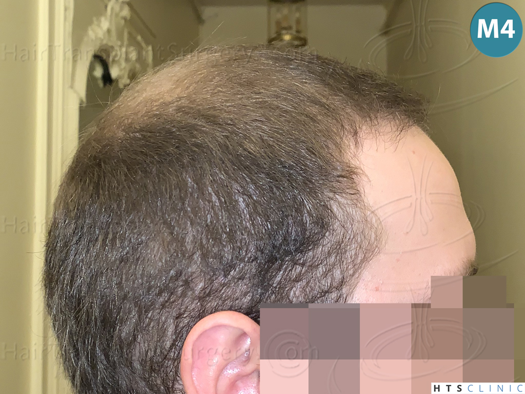 Dr.Devroye-HTS-Clinic-3054-FUE-19