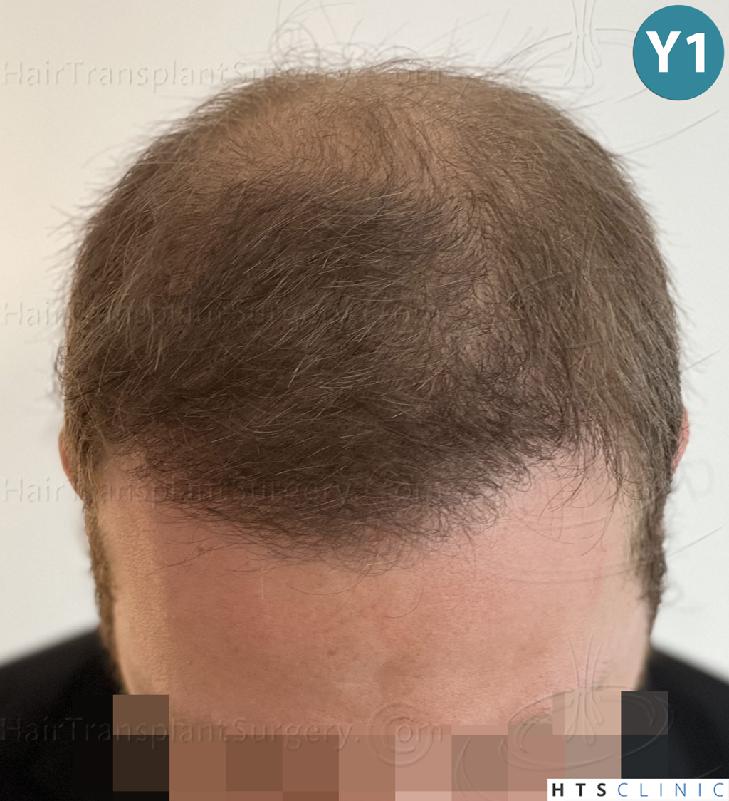 Dr.Devroye-HTS-Clinic-3054-FUE-25