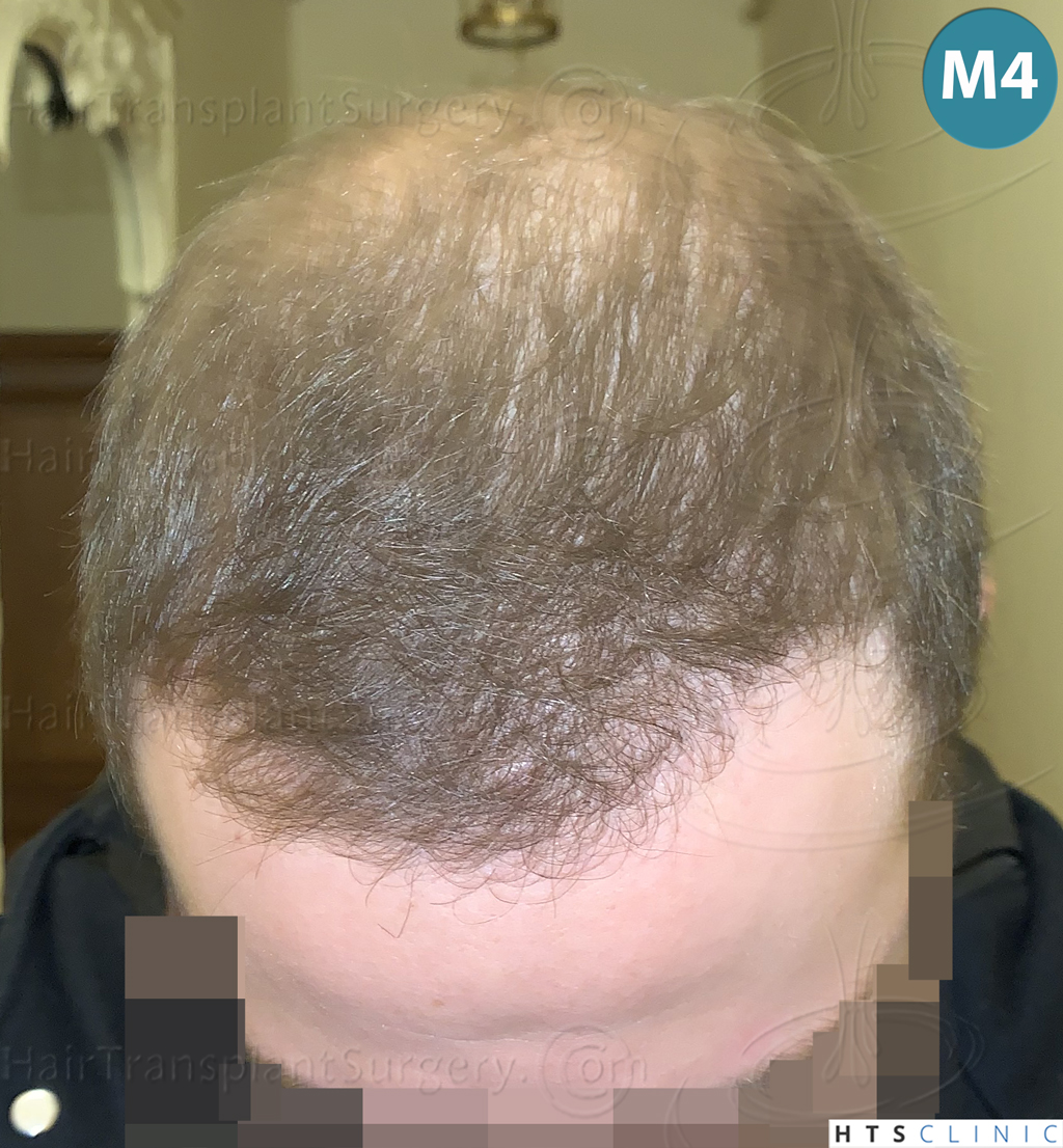 Dr.Devroye-HTS-Clinic-3054-FUE-17