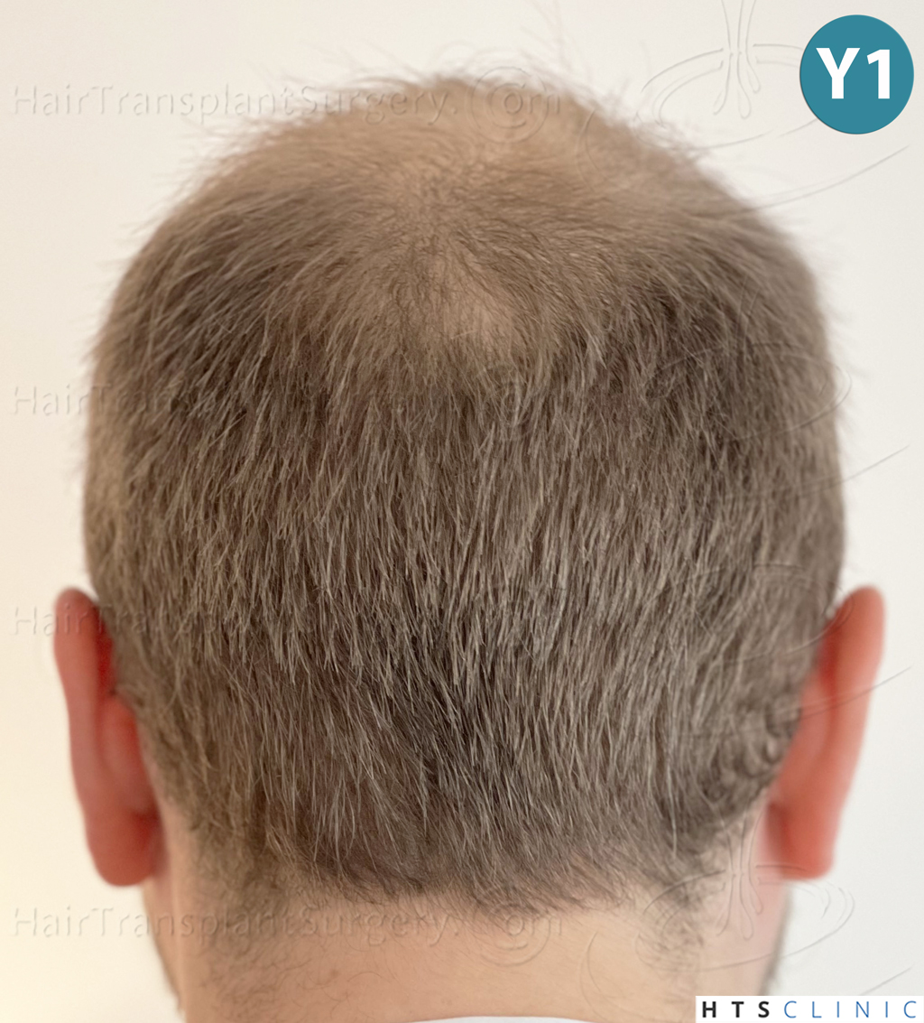 Dr.Devroye-HTS-Clinic-3054-FUE-28