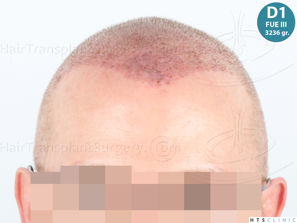 Dr.Devroye-HTS-Clinic-9730-FUE-BHT-NW-VI