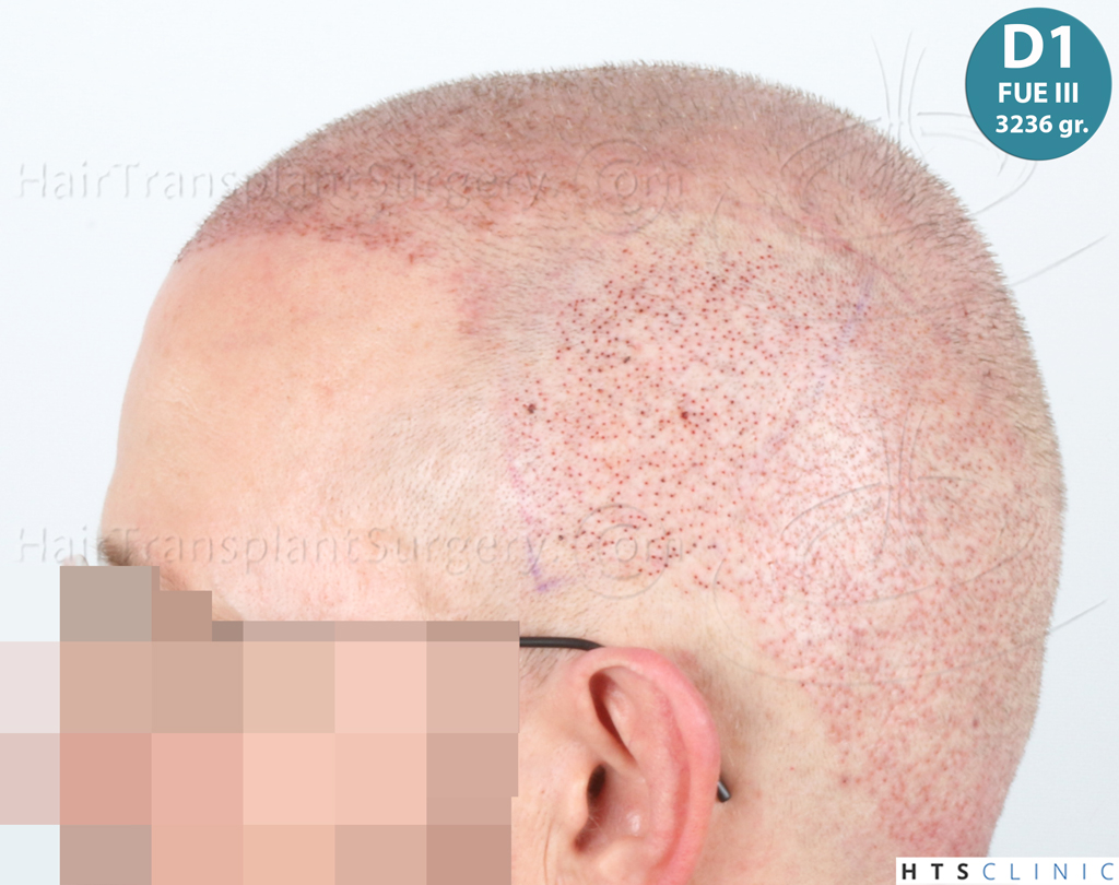 Dr.Devroye-HTS-Clinic-9730-FUE-BHT-NW-VI