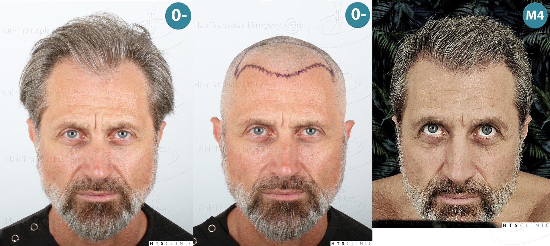 Dr.Devroye-HTS-Clinic-2255-FUE-NW-III-Montage-1.jpg