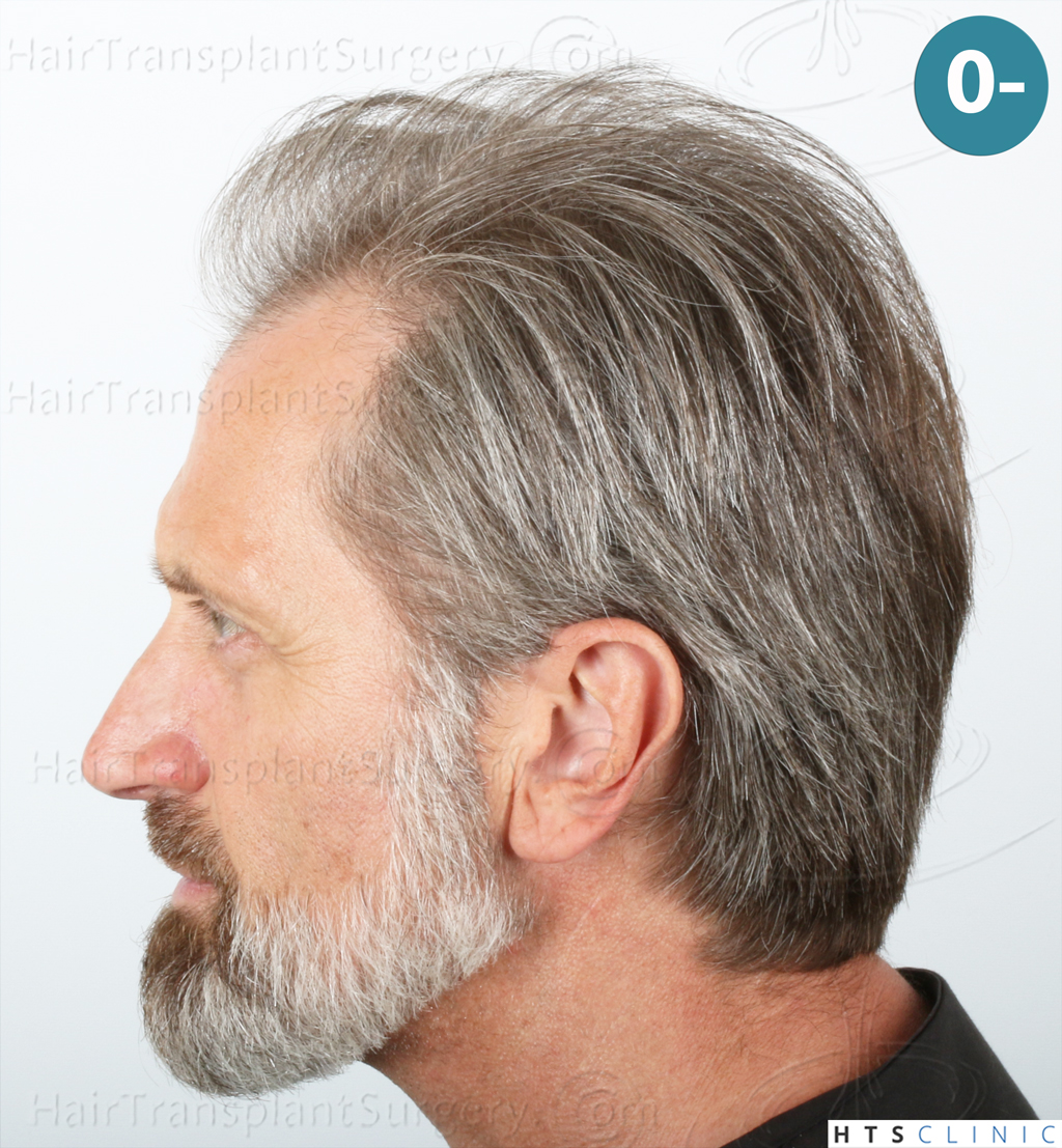 Dr.Devroye-HTS-Clinic-2255-FUE-NW-III-2.