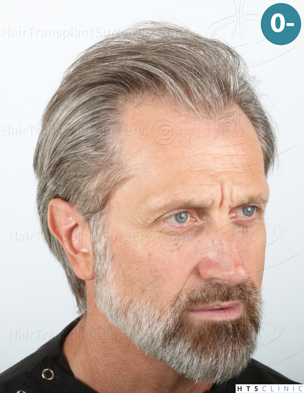 Dr.Devroye-HTS-Clinic-2255-FUE-NW-III-5.jpg