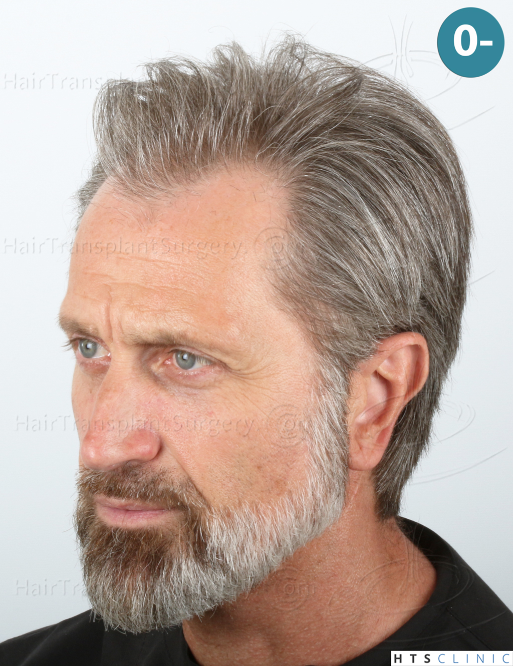 Dr.Devroye-HTS-Clinic-2255-FUE-NW-III-3.jpg