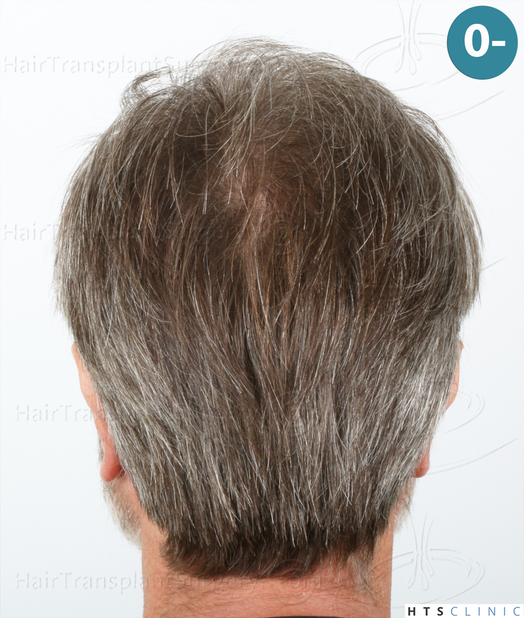 Dr.Devroye-HTS-Clinic-2255-FUE-NW-III-6.