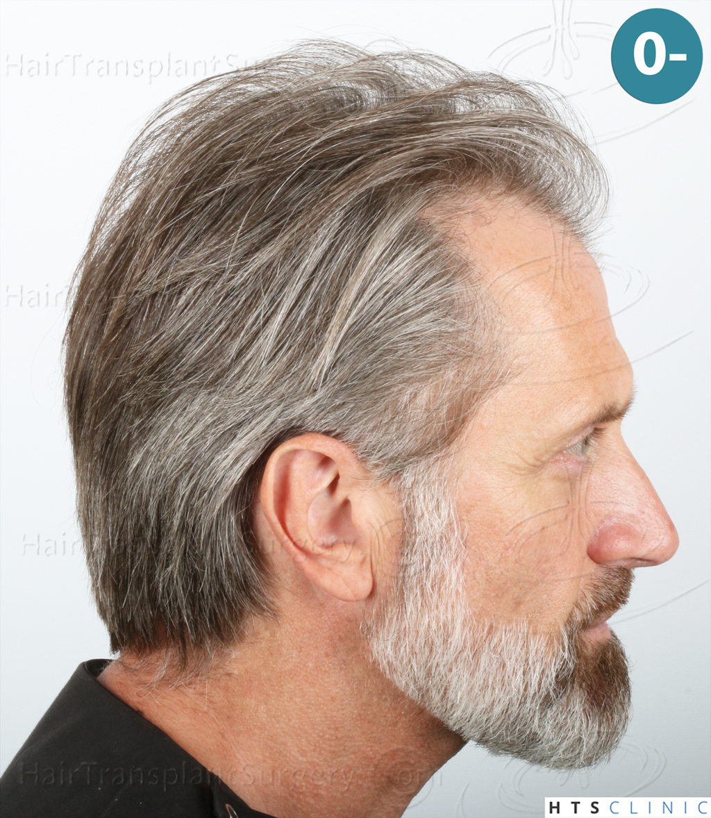 Dr.Devroye-HTS-Clinic-2255-FUE-NW-III-4.