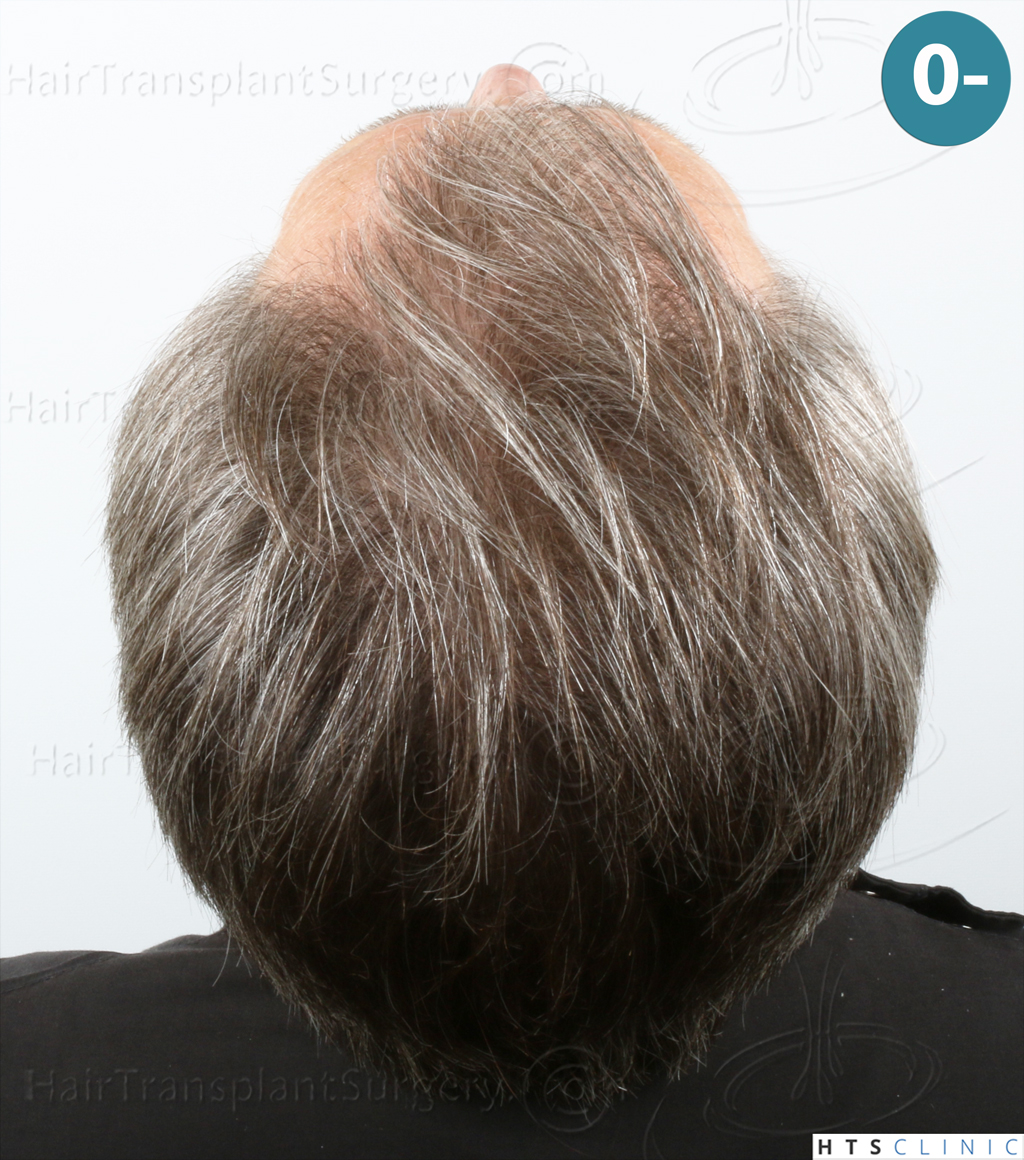 Dr.Devroye-HTS-Clinic-2255-FUE-NW-III-7.jpg