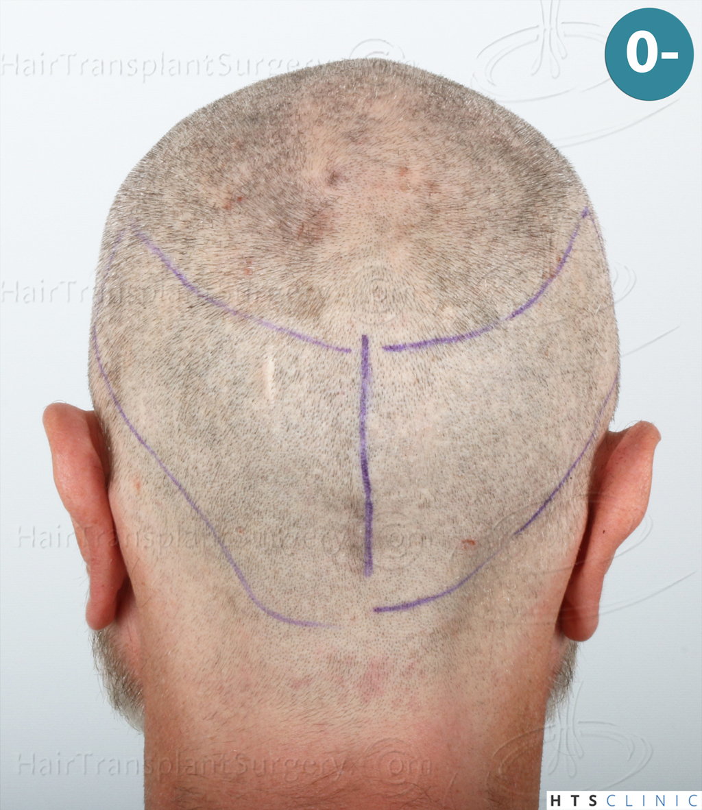 Dr.Devroye-HTS-Clinic-2255-FUE-NW-III-8.jpg