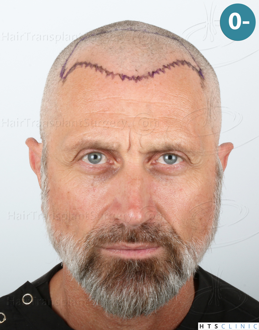 Dr.Devroye-HTS-Clinic-2255-FUE-NW-III-9.jpg