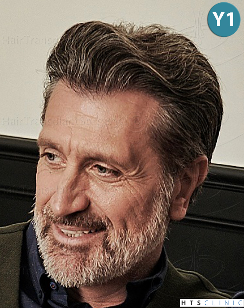 Dr.Devroye-HTS-Clinic-2255-FUE-NW-III-17.jpg