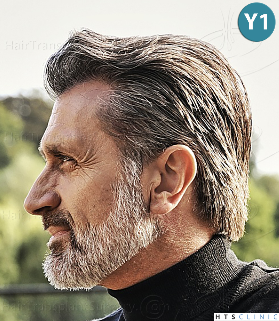Dr.Devroye-HTS-Clinic-2255-FUE-NW-III-16.jpg