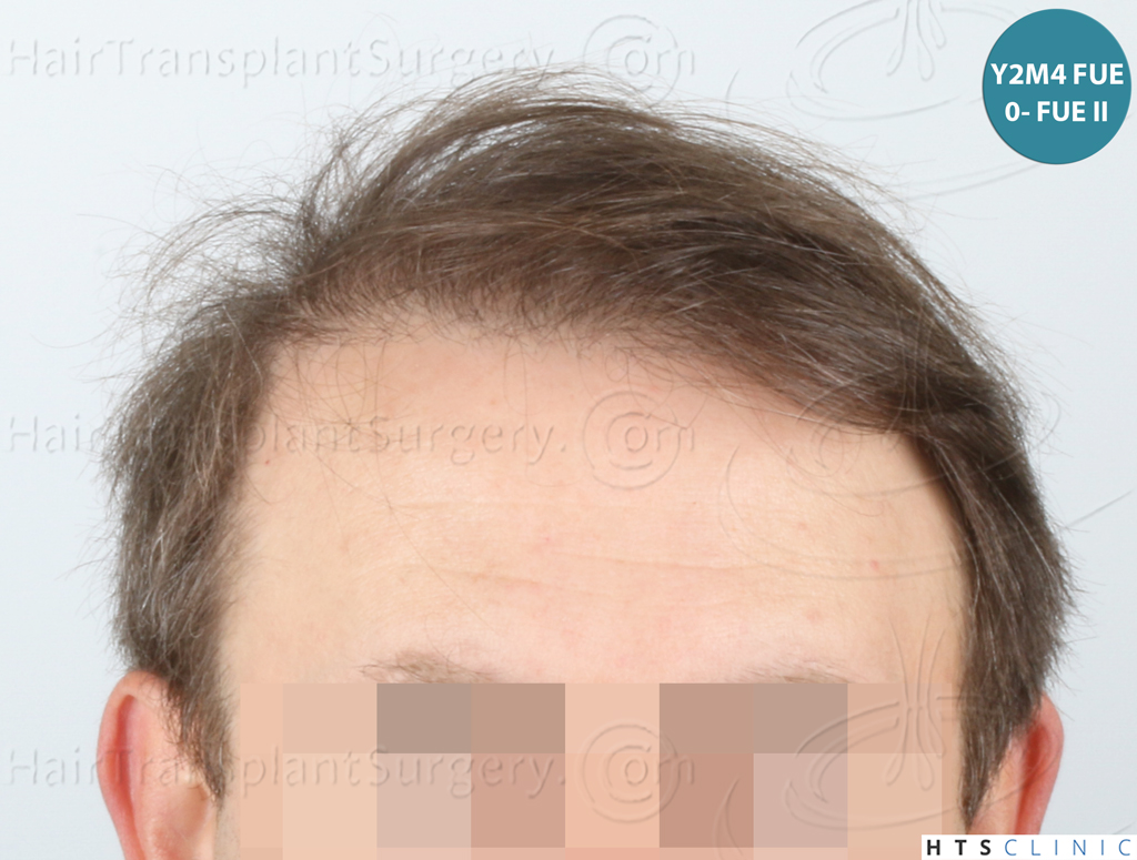 Dr.Devroye-HTS-Clinic-4724-FUE-NW-VI-23.