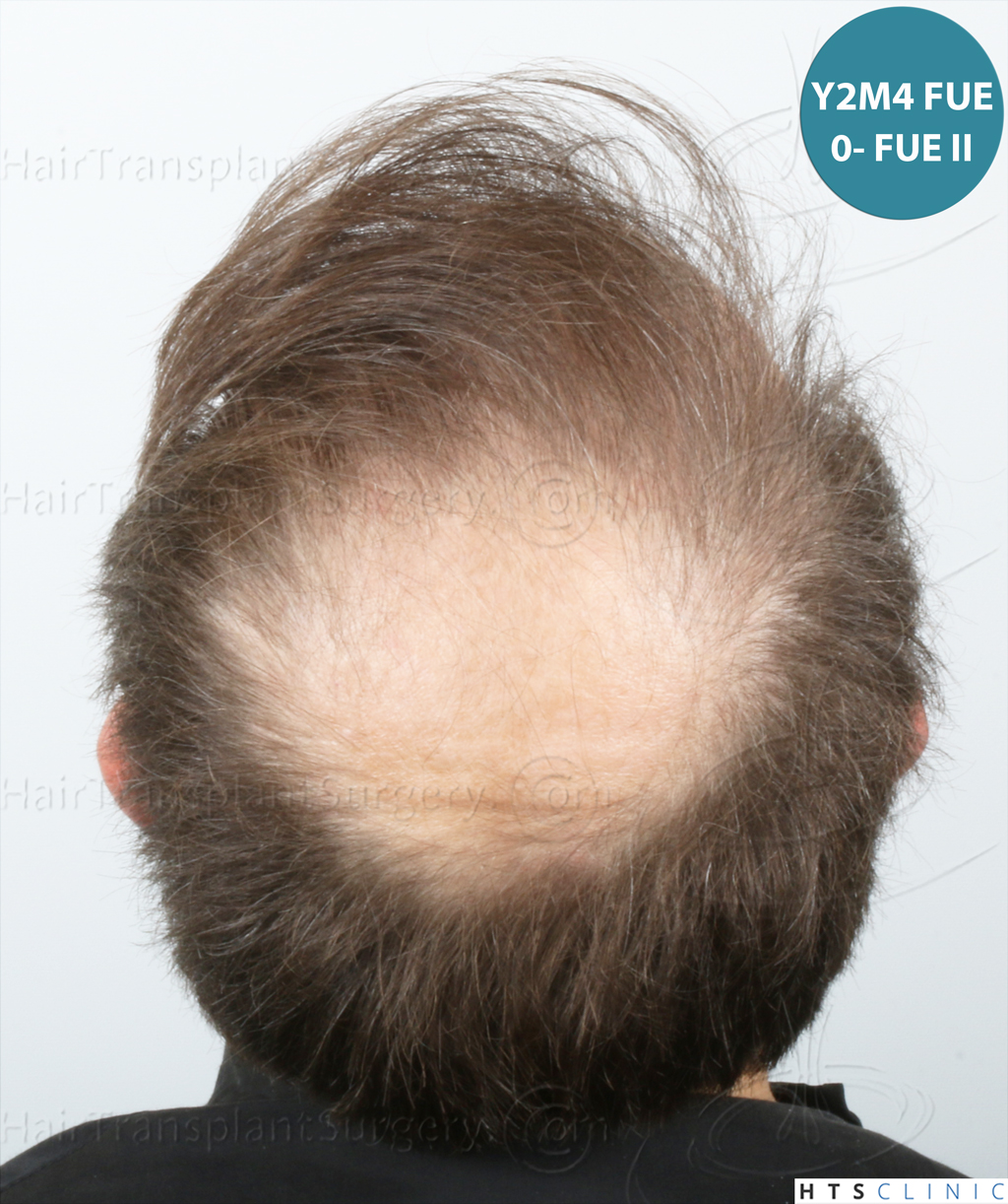 Dr.Devroye-HTS-Clinic-4724-FUE-NW-VI-29.