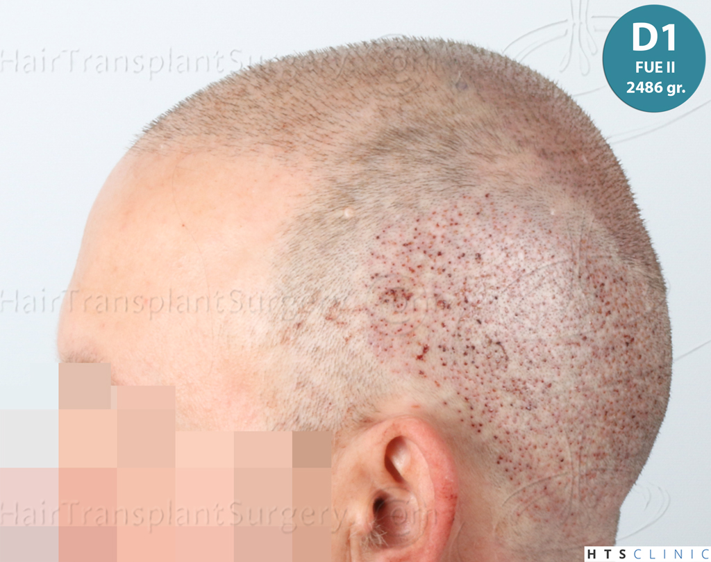 Dr.Devroye-HTS-Clinic-4724-FUE-NW-VI-32.