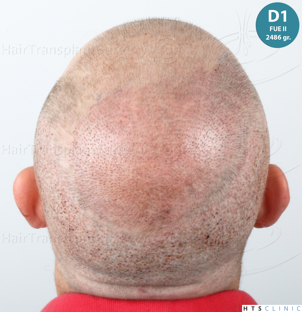 Dr.Devroye-HTS-Clinic-4724-FUE-NW-VI-35.