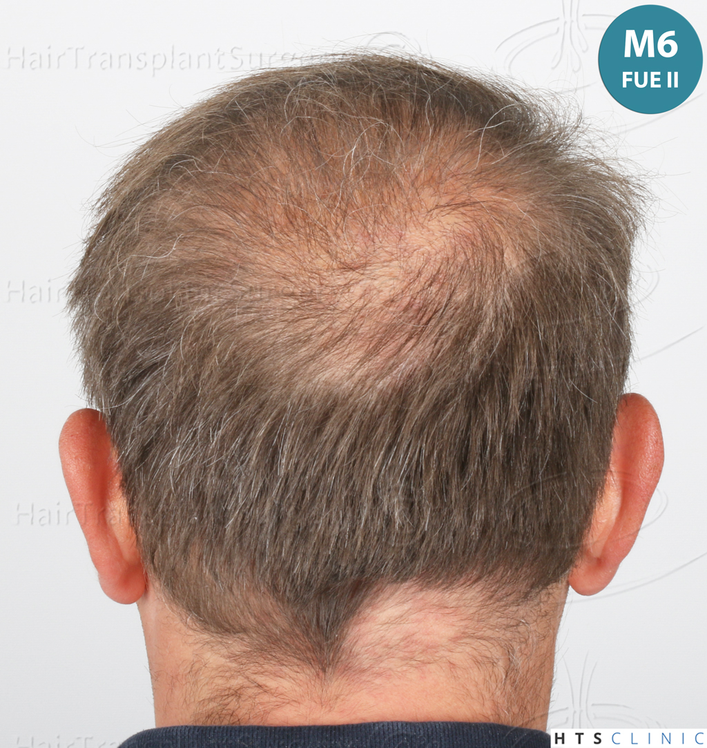 Dr.Devroye-HTS-Clinic-4724-FUE-NW-VI-36.