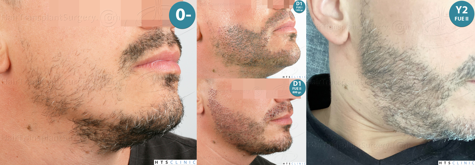 Dr.Devroye-HTS-Clinic-2191-Beard-FUE-Mon