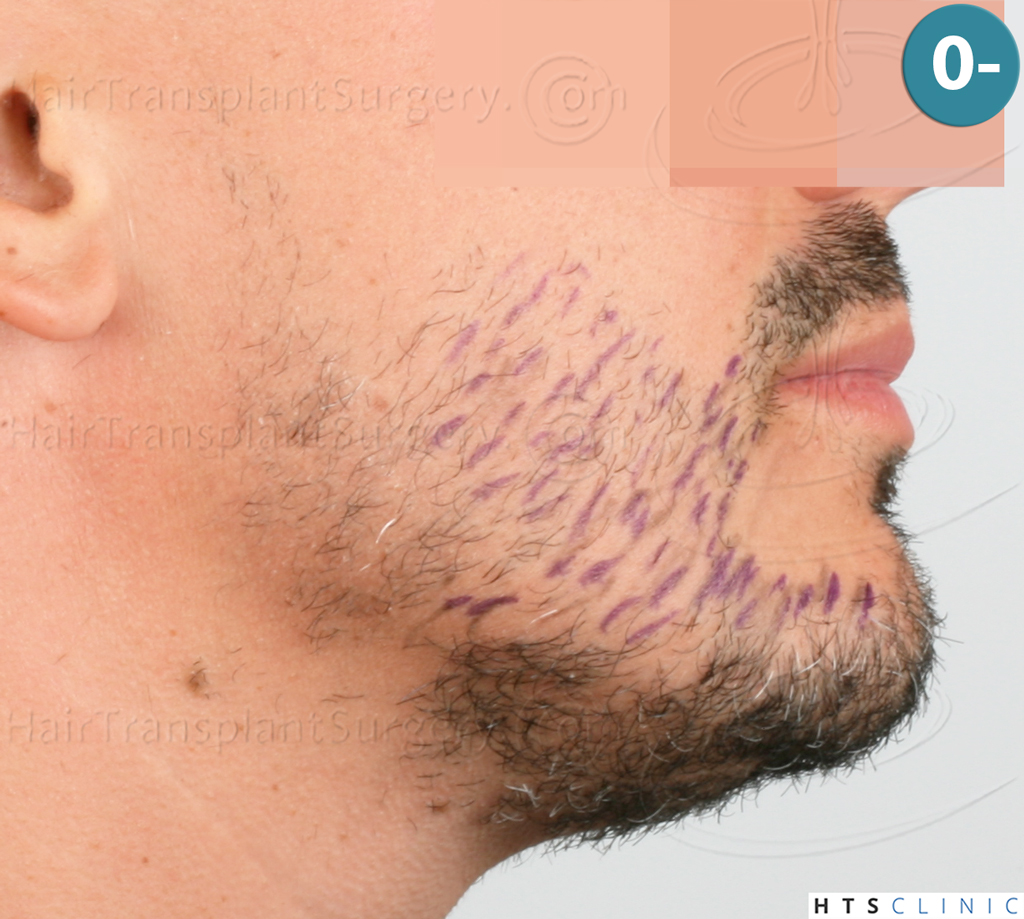 Dr.Devroye-HTS-Clinic-2191-Beard-FUE-6.j