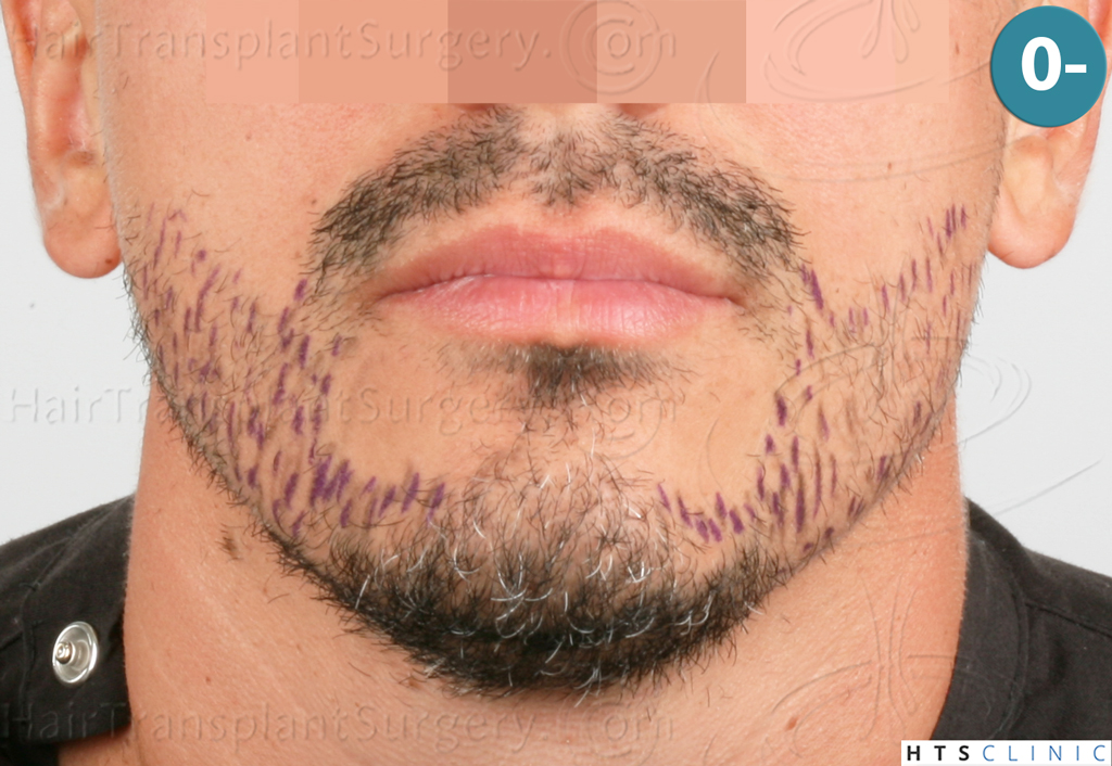 Dr.Devroye-HTS-Clinic-2191-Beard-FUE-4.j