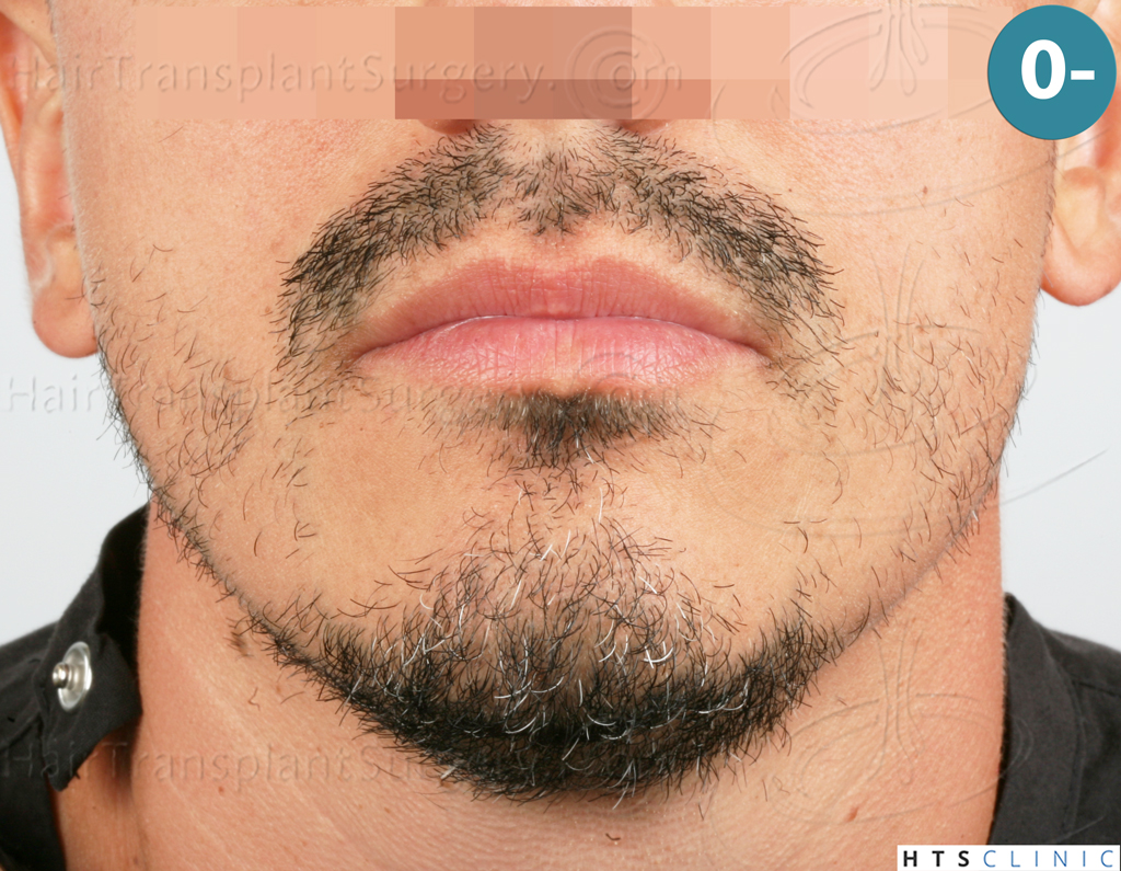 Dr.Devroye-HTS-Clinic-2191-Beard-FUE-1.j