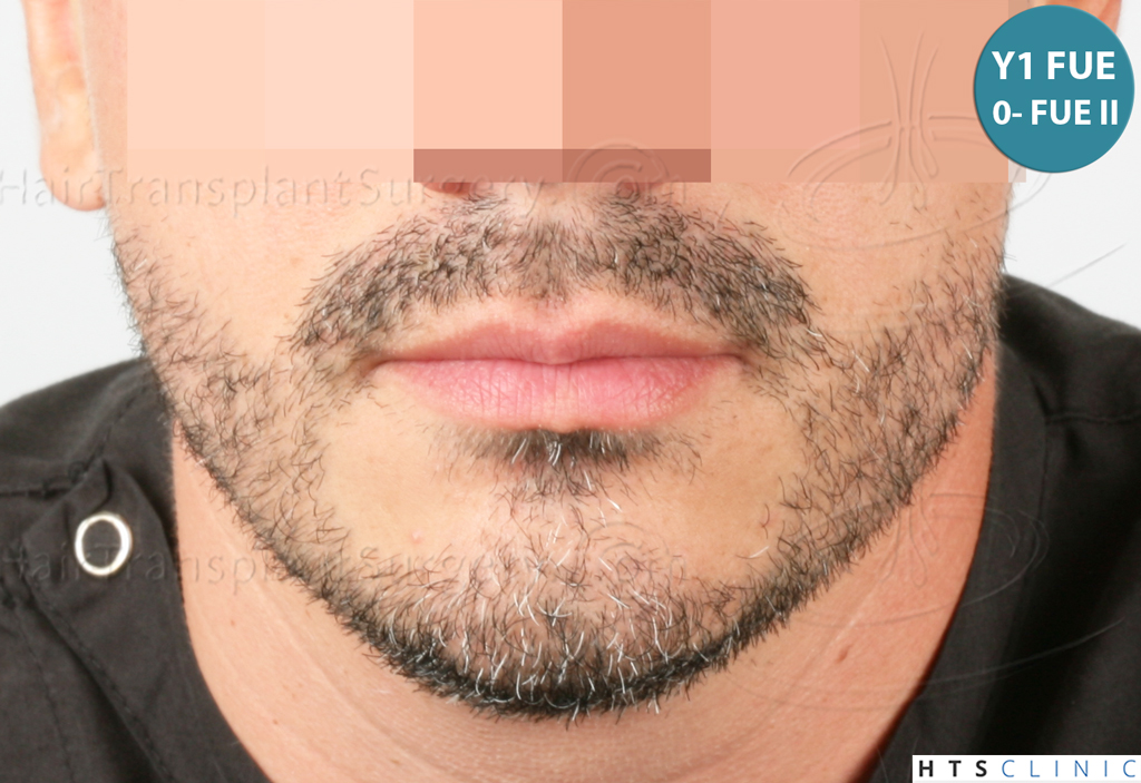 Dr.Devroye-HTS-Clinic-2191-Beard-FUE-12.