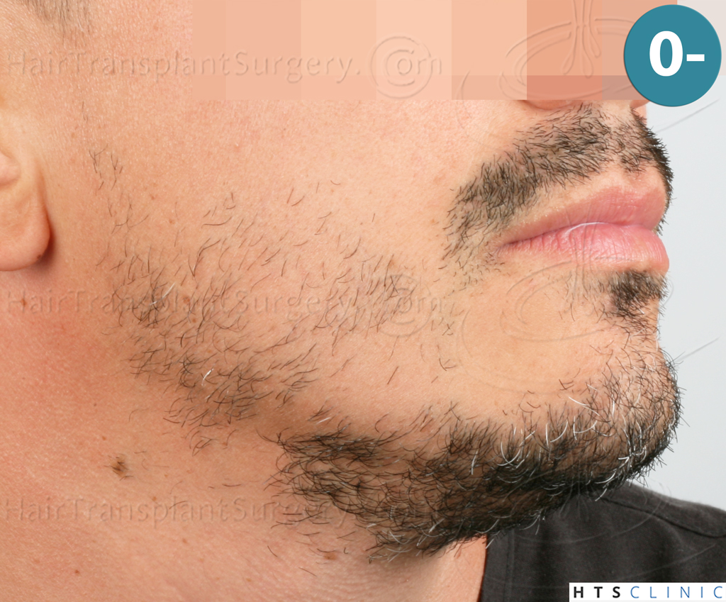 Dr.Devroye-HTS-Clinic-2191-Beard-FUE-3.j