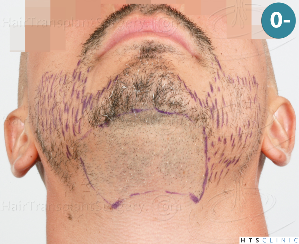 Dr.Devroye-HTS-Clinic-2191-Beard-FUE-7.j