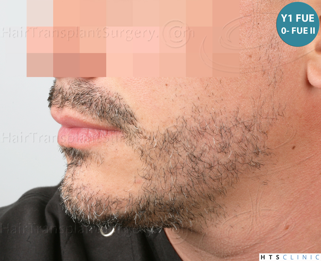 Dr.Devroye-HTS-Clinic-2191-Beard-FUE-13.