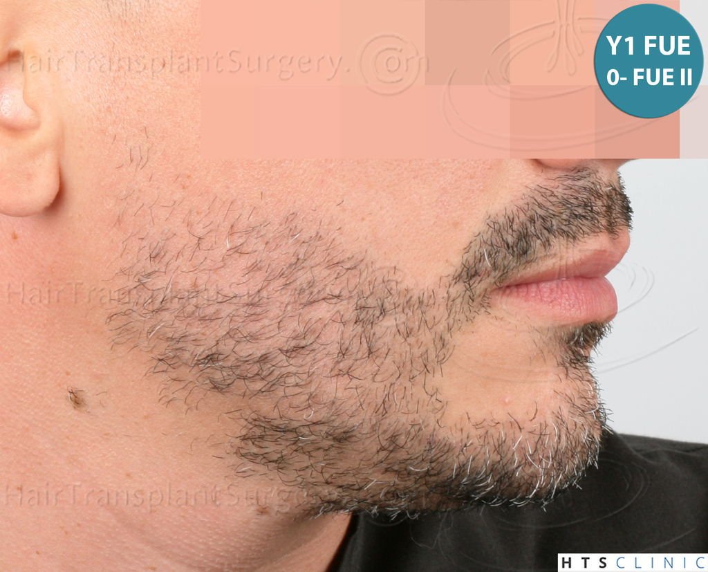 Dr.Devroye-HTS-Clinic-2191-Beard-FUE-14.