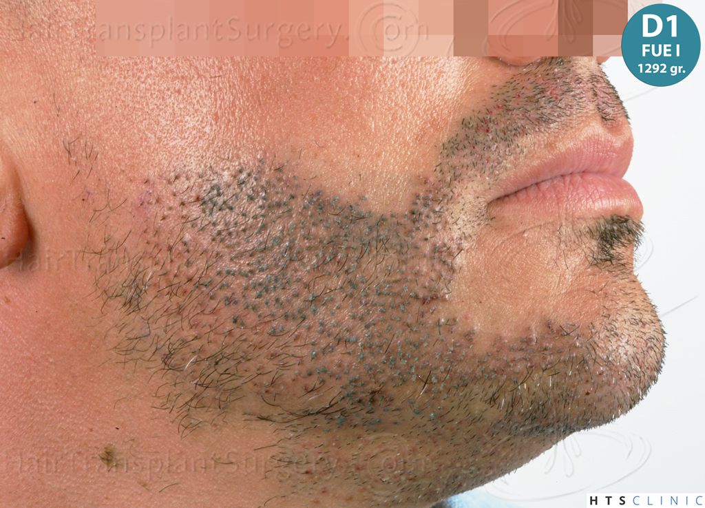 Dr.Devroye-HTS-Clinic-2191-Beard-FUE-10.