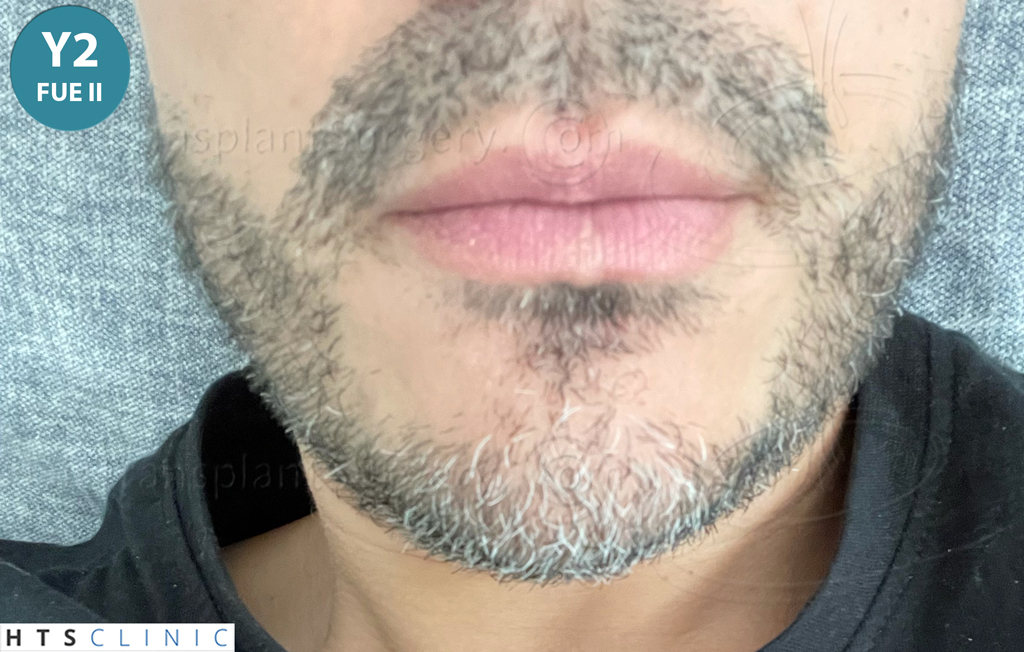 Dr.Devroye-HTS-Clinic-2191-Beard-FUE-21.