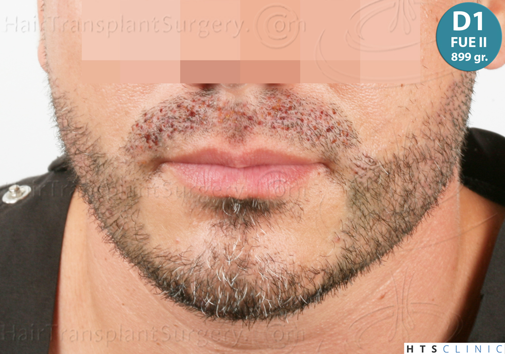 Dr.Devroye-HTS-Clinic-2191-Beard-FUE-18.